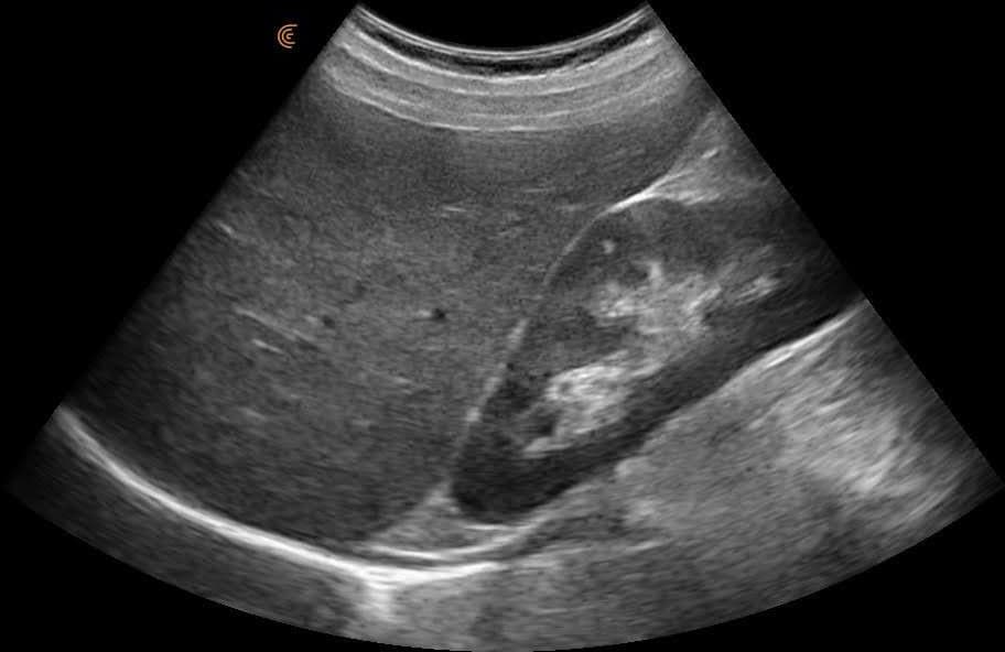 Échographie abdominale du foie et du rein