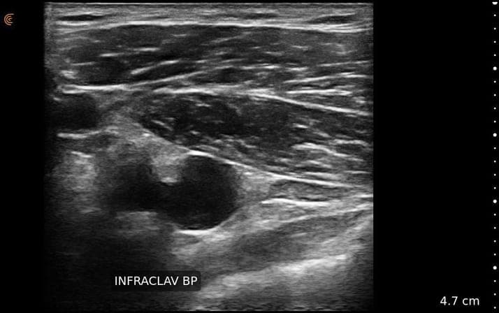 Plexus infraclaviculaire
