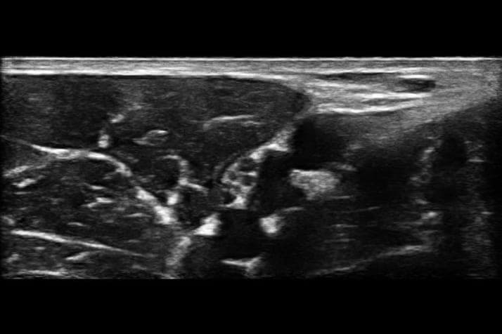 Plexus brachial axillaire