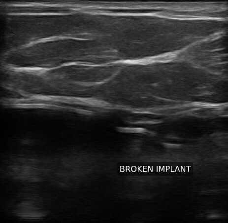 Imagerie d'implant mammaire rompu