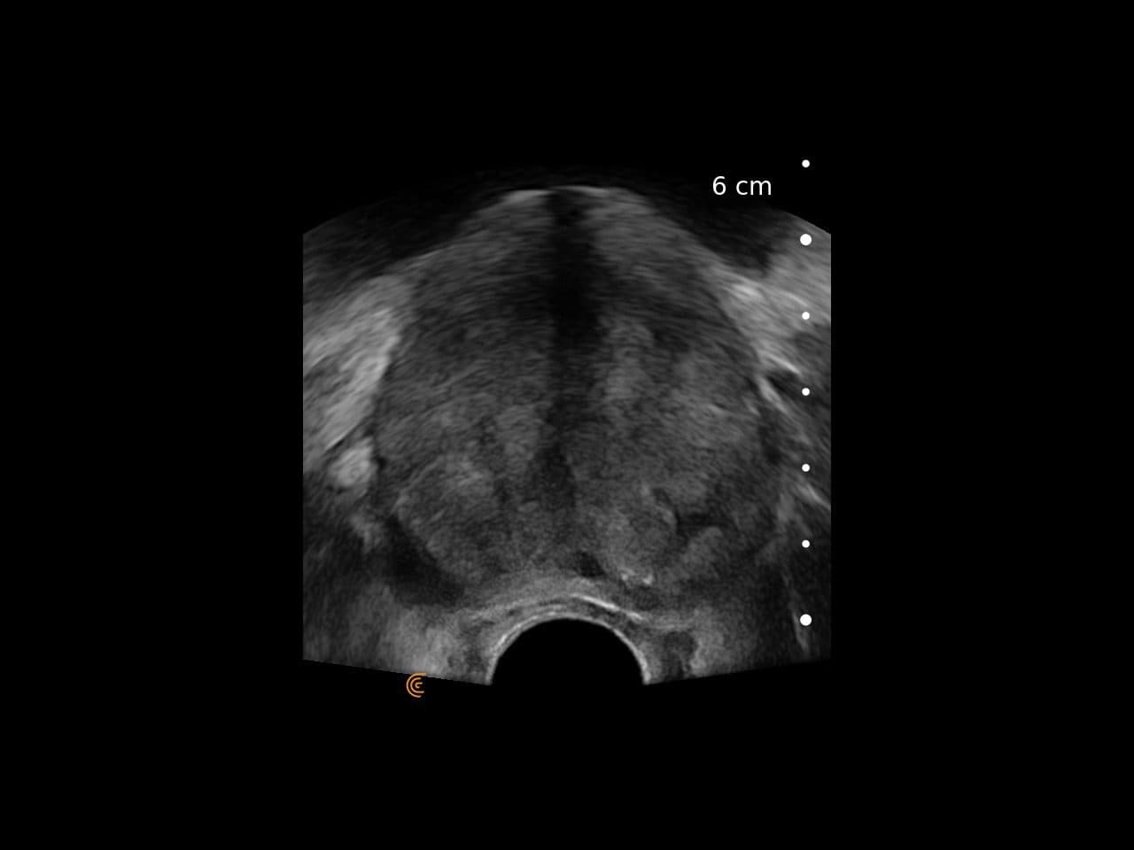 Prostate TRUS