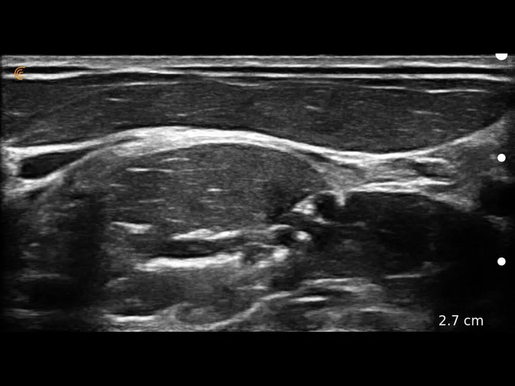 Plexus brachial interscalénique ; galerie clinique Clarius. Modèle d’acquisition non précisé pour cette image clinique.