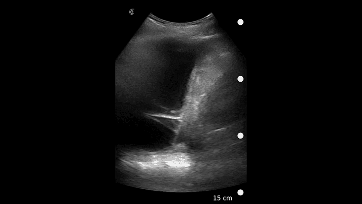 Épanchement pleural fibrotique