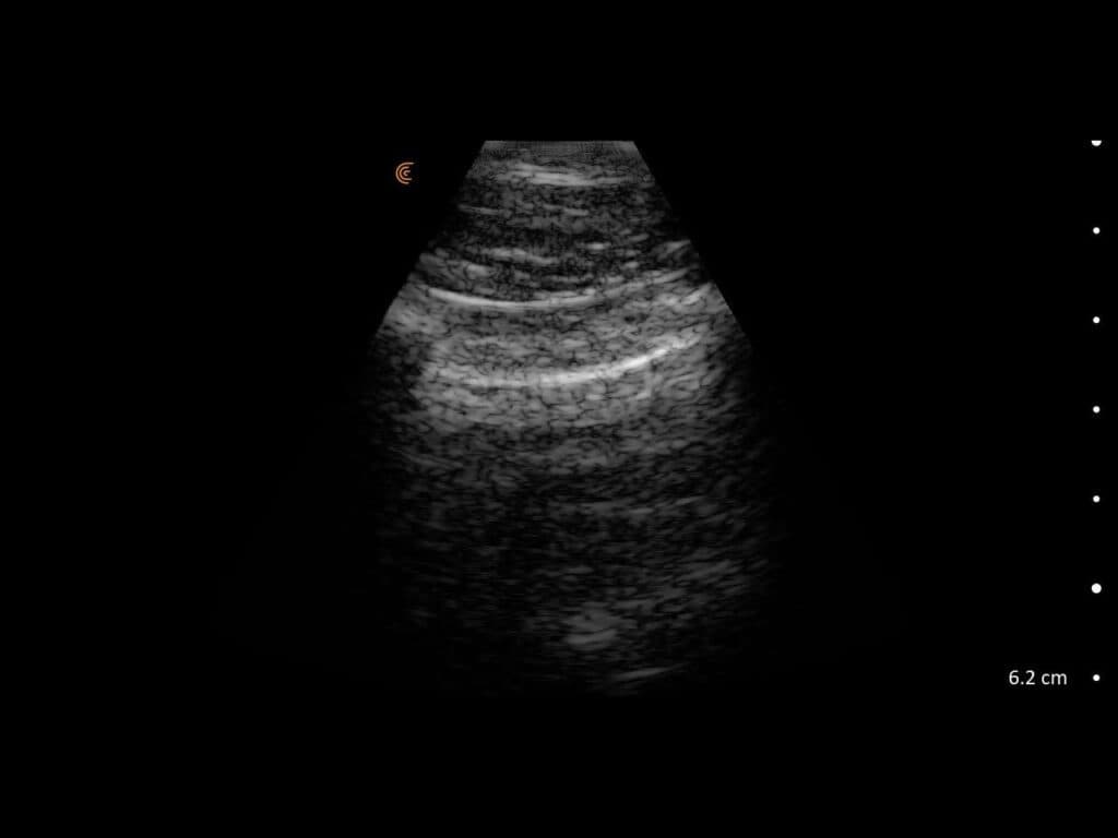 Glissement pulmonaire à l'échographie
