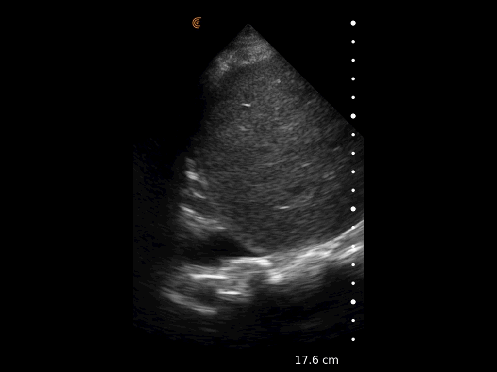 Épanchement pleural droit