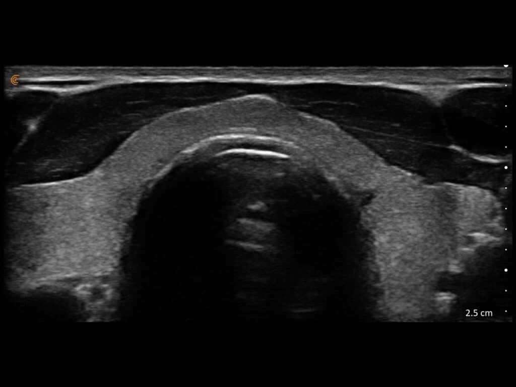 Évaluation de l'isthme thyroïdien