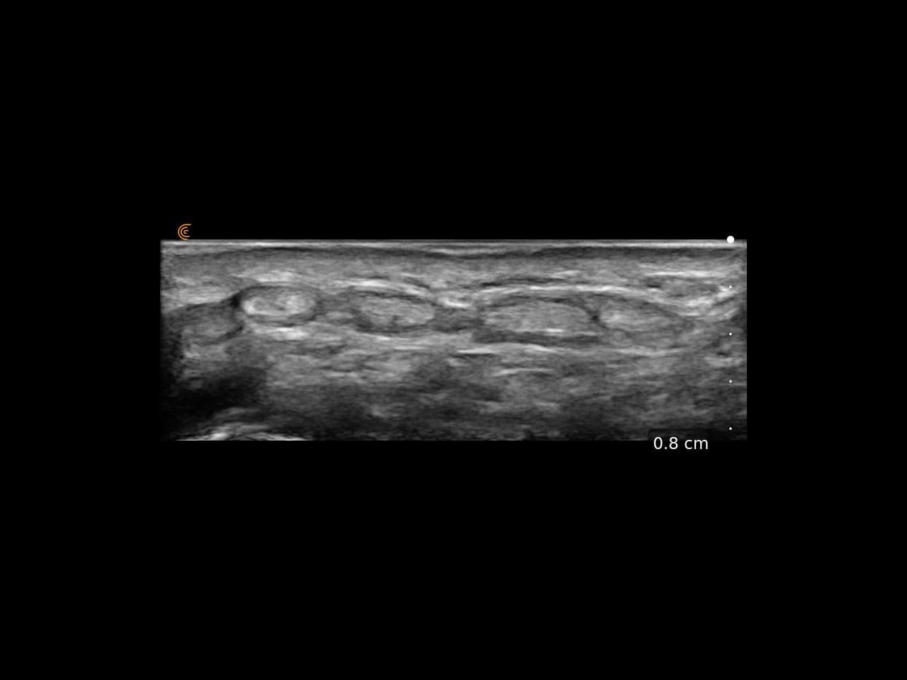 Tendons extenseurs du poignet