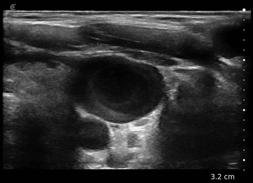 Thrombus VJI