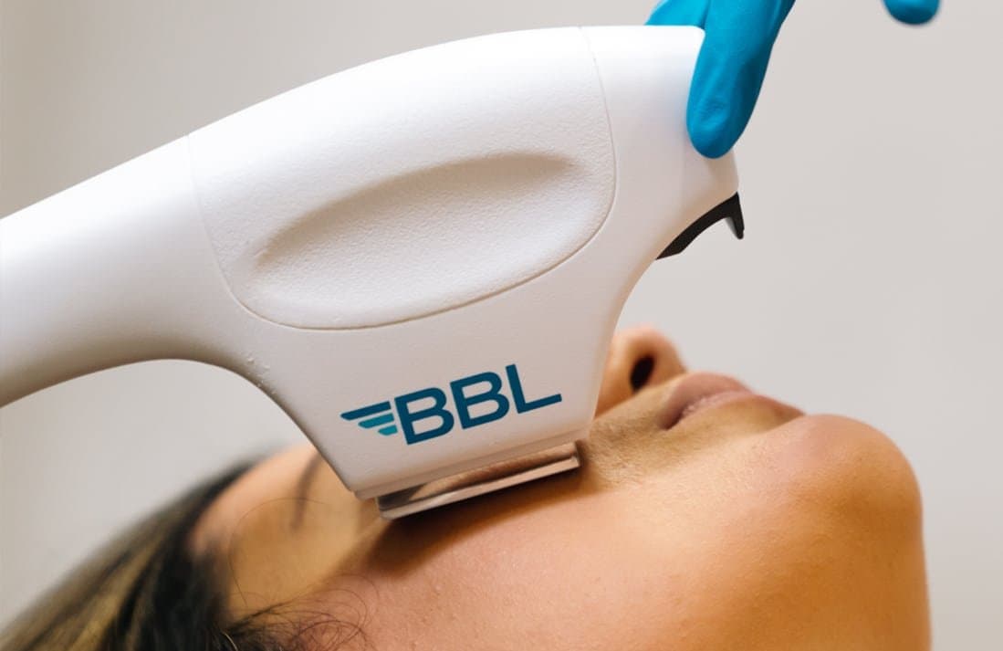 BBL® HERO : Technologie de Lumière Pulsée pour les Lésions Pigmentées et Vasculaires