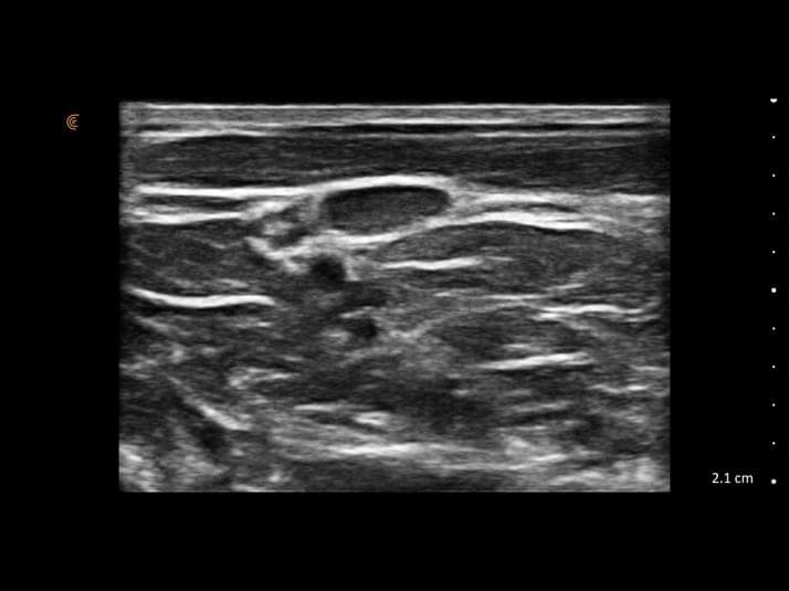 Plexus brachial interscalénique