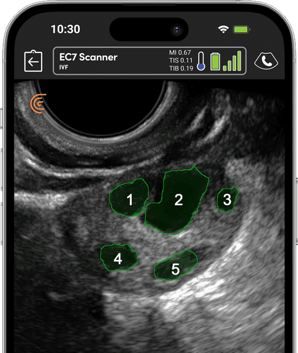 Outils d'IVF