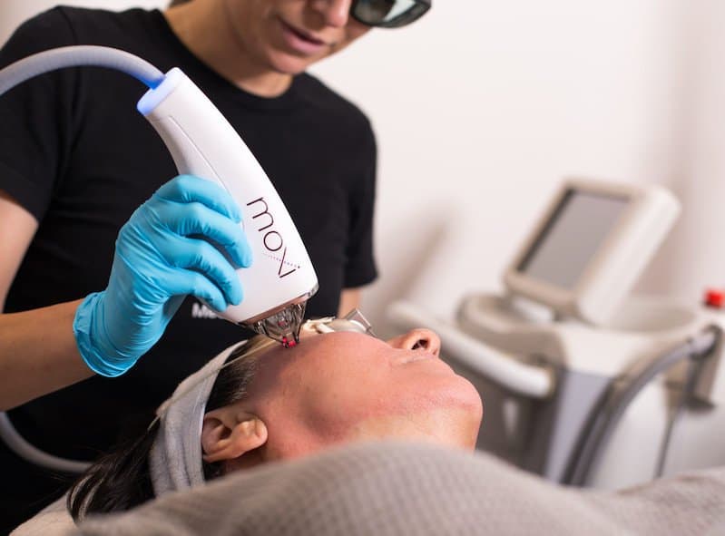 MOXI™ : Laser Doux pour le Rajeunissement de la Peau