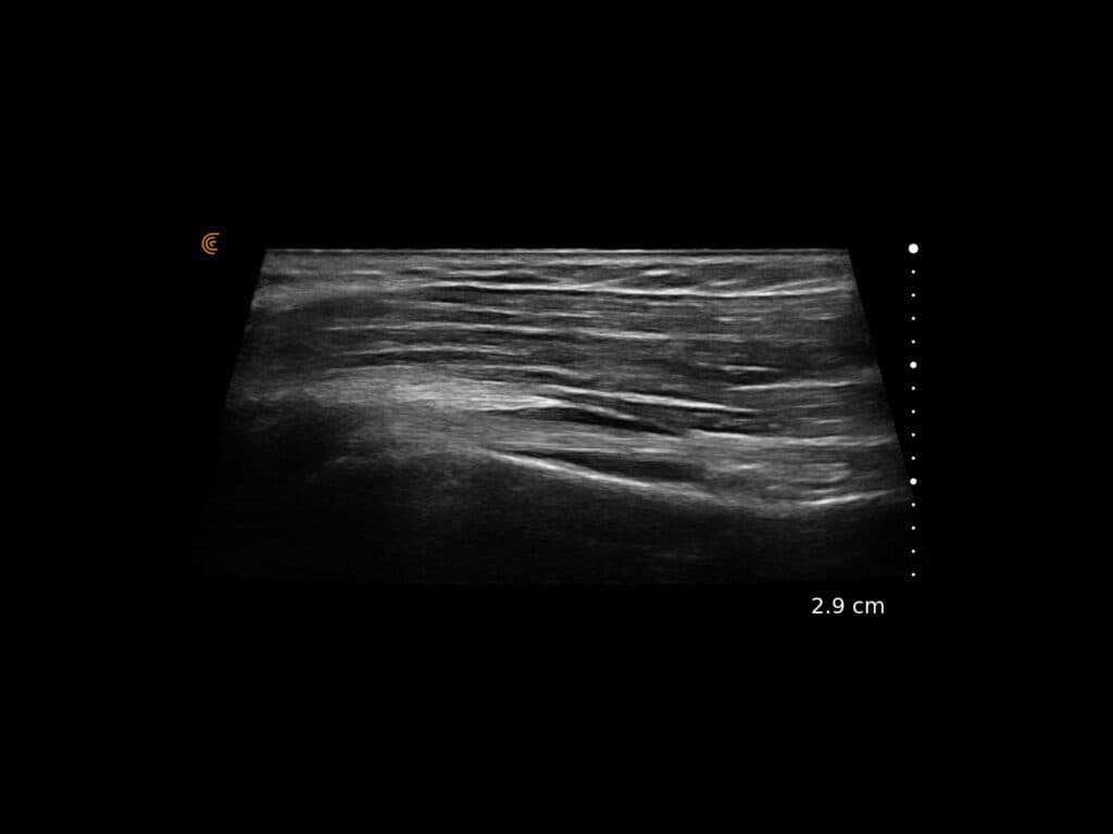 Tendon long du biceps avec trapèze