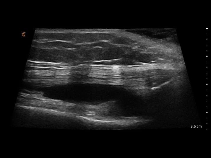 Épanchement suprapatellaire