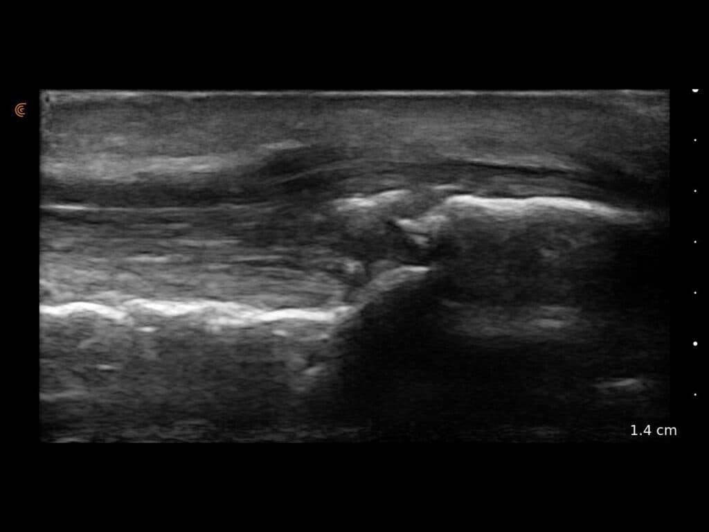 Fracture de la rotule et déchirure du tendon