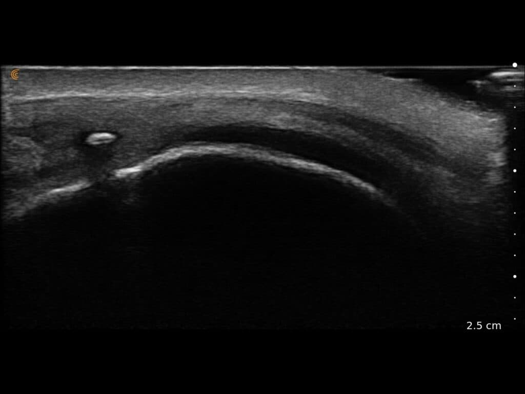 Calcification du tendon du quadriceps