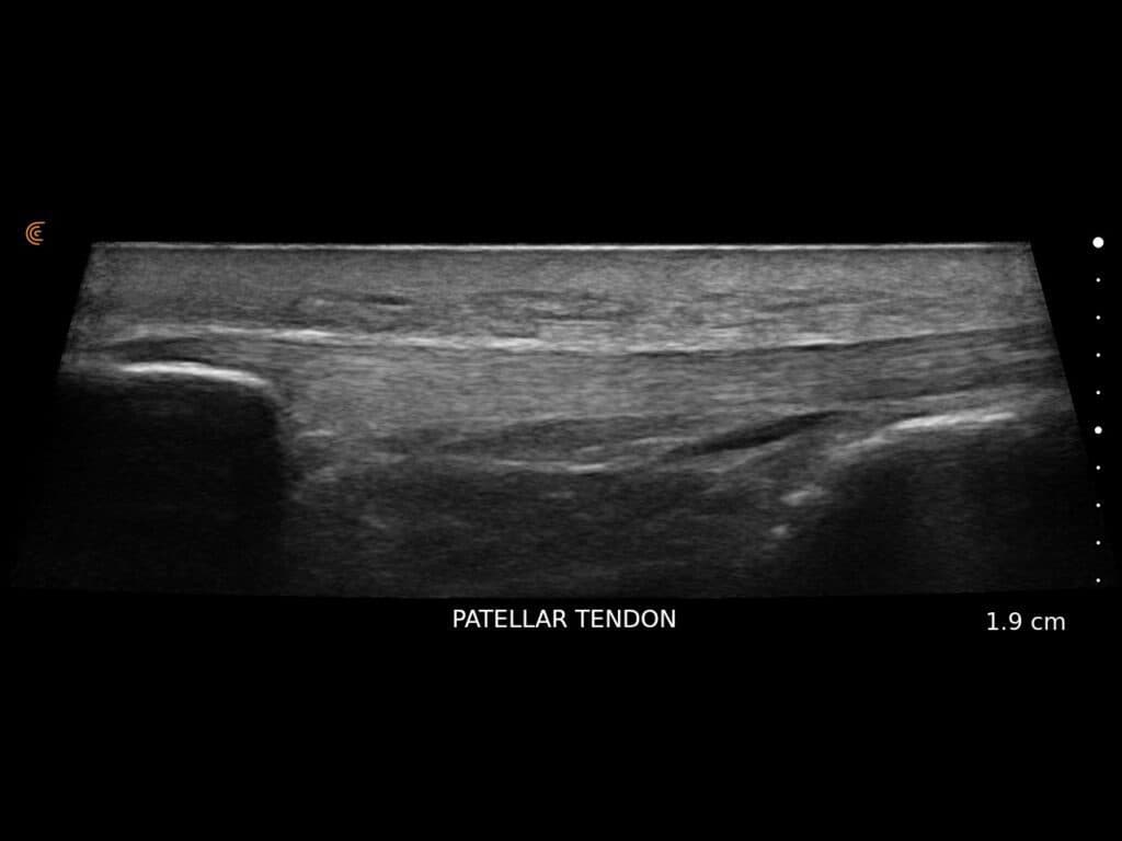 Tendon rotulien avec artefact trapézoïdal