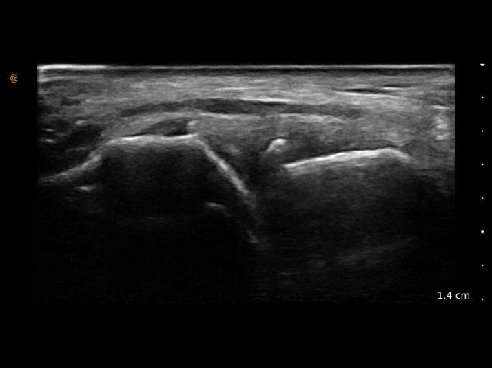 Arthrose de l'articulation scapho-trapézoïdienne