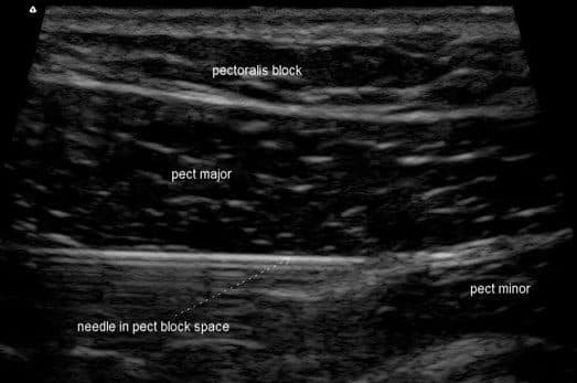 Bloc PEC