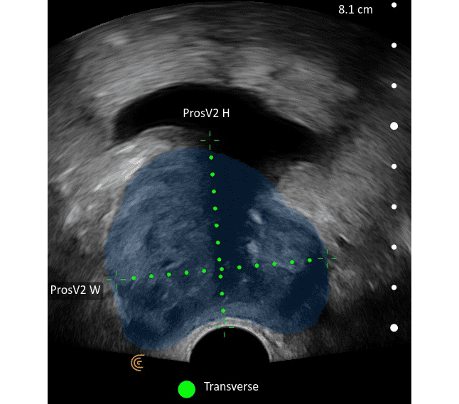 IA de la prostate transrectale