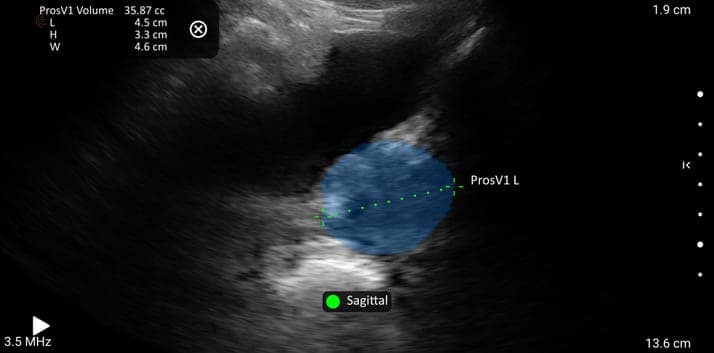 IA de la prostate transabdominale