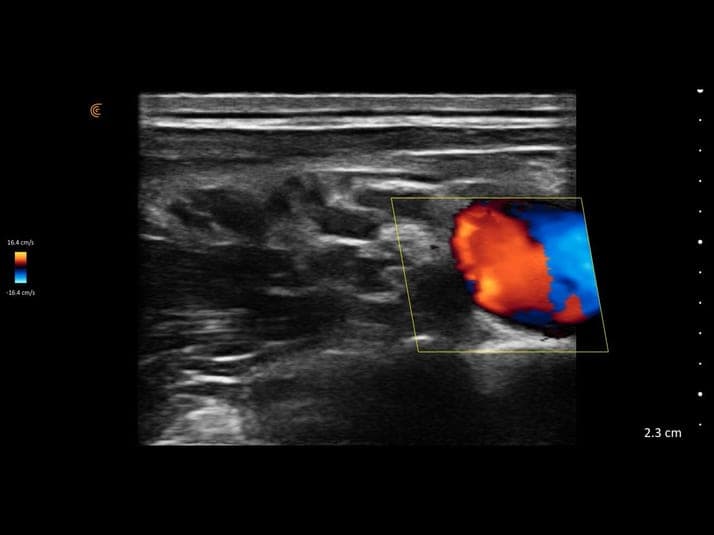 Plexus brachial supraclaviculaire