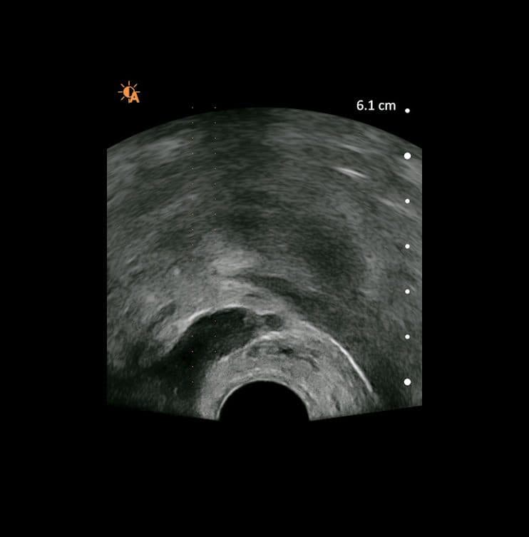 Bloc périprostatique transrectal