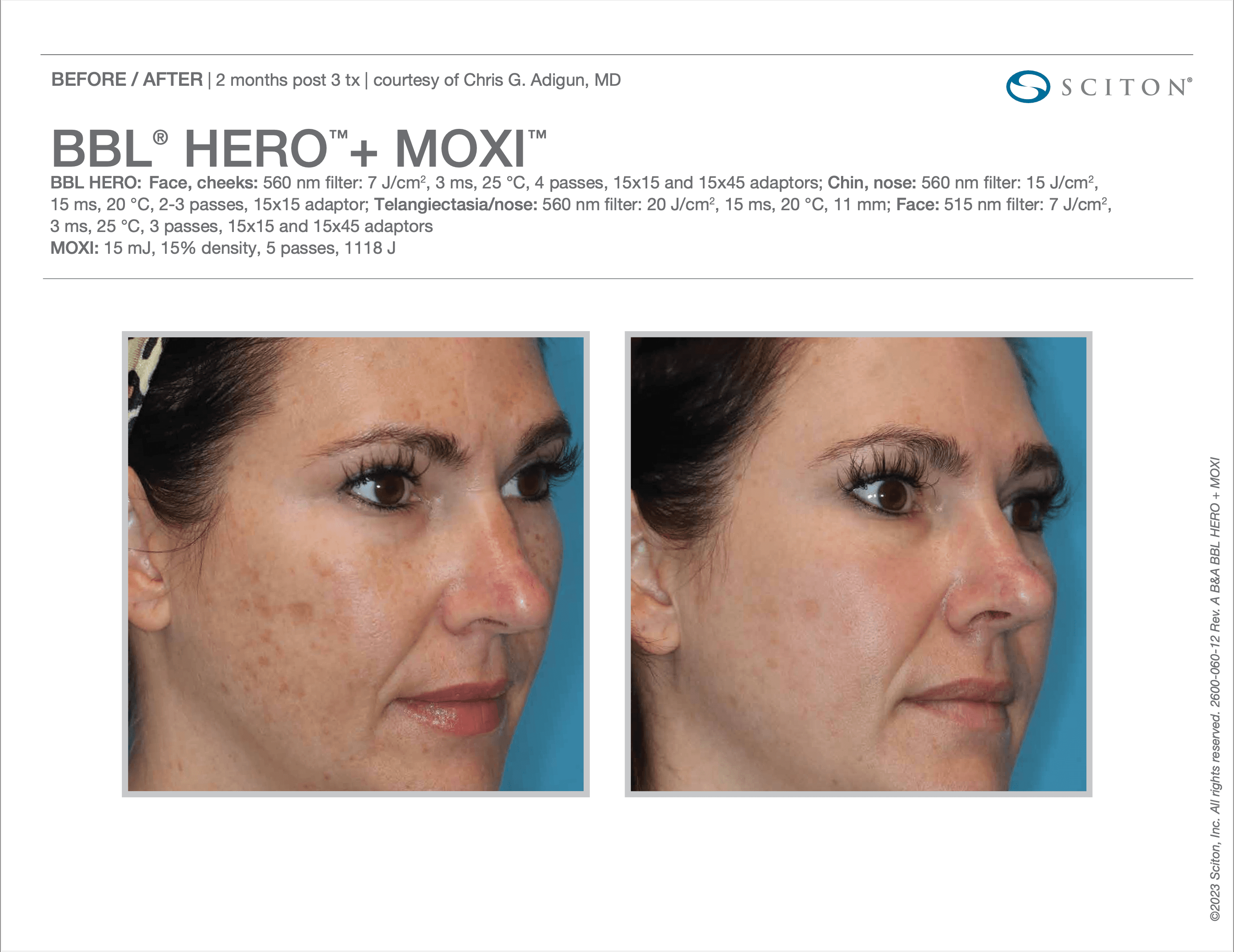 Avant/après BBL HERO + MOXI — pigmentation du visage atténuée (document Sciton)