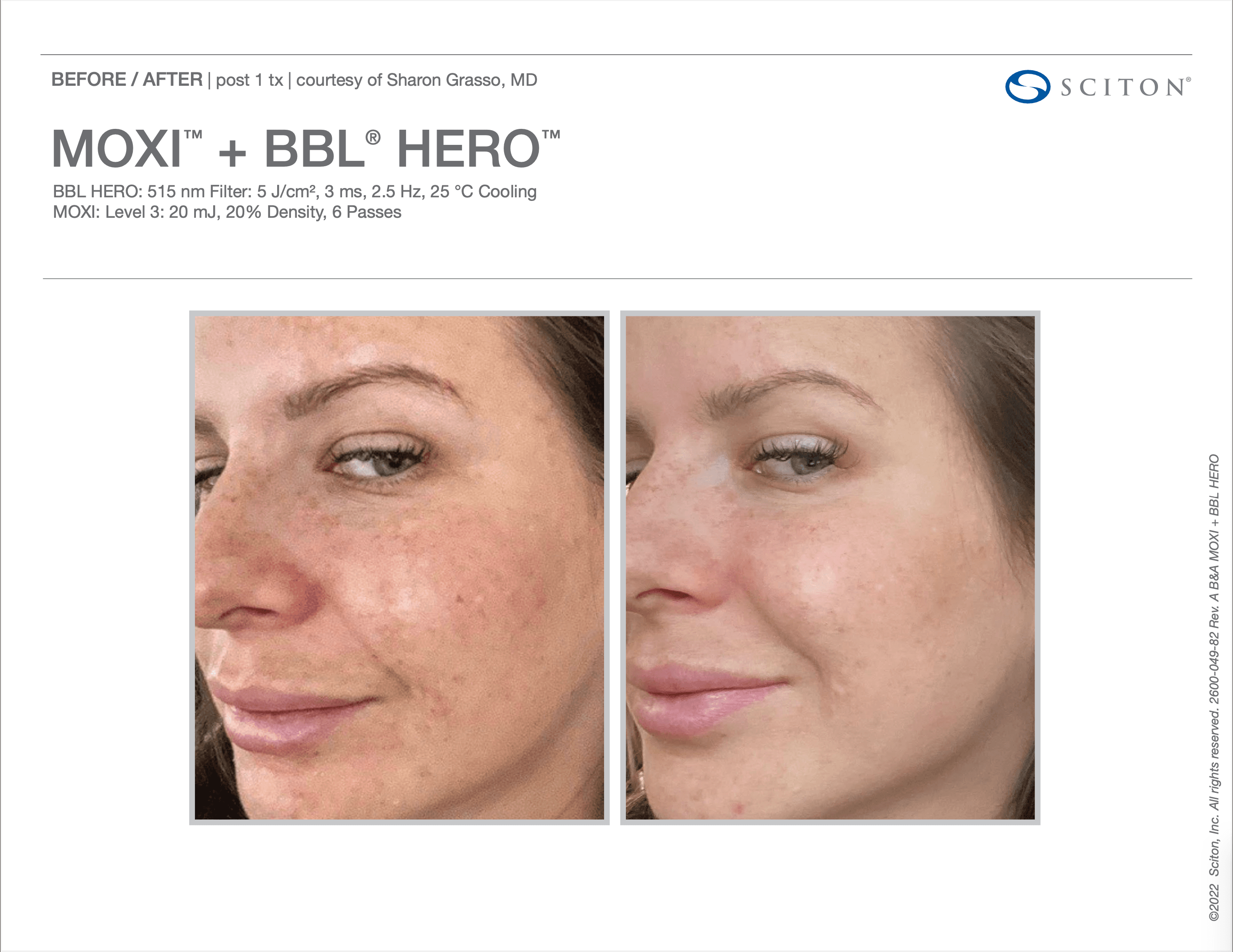 Avant/après laser Sciton BBL HERO + MOXI (document fabricant)