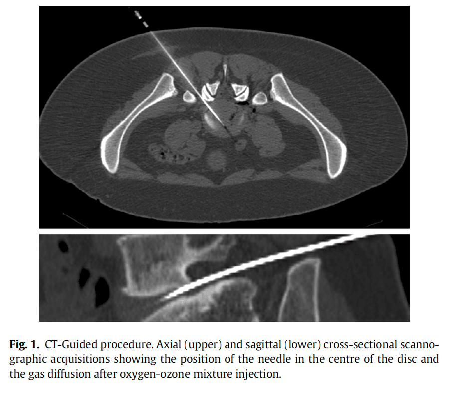 Figure 2 — Intradiscal Ozone Therapy for Disc Herniation