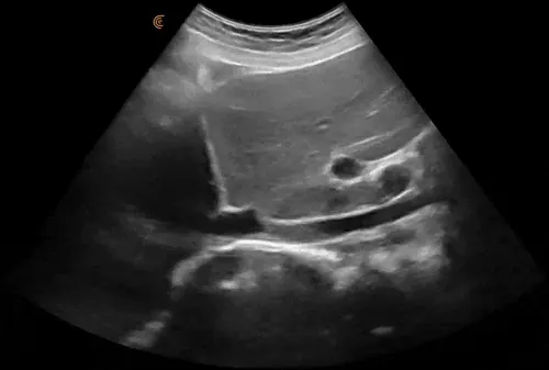 Foie et VCI sur échographie abdominale